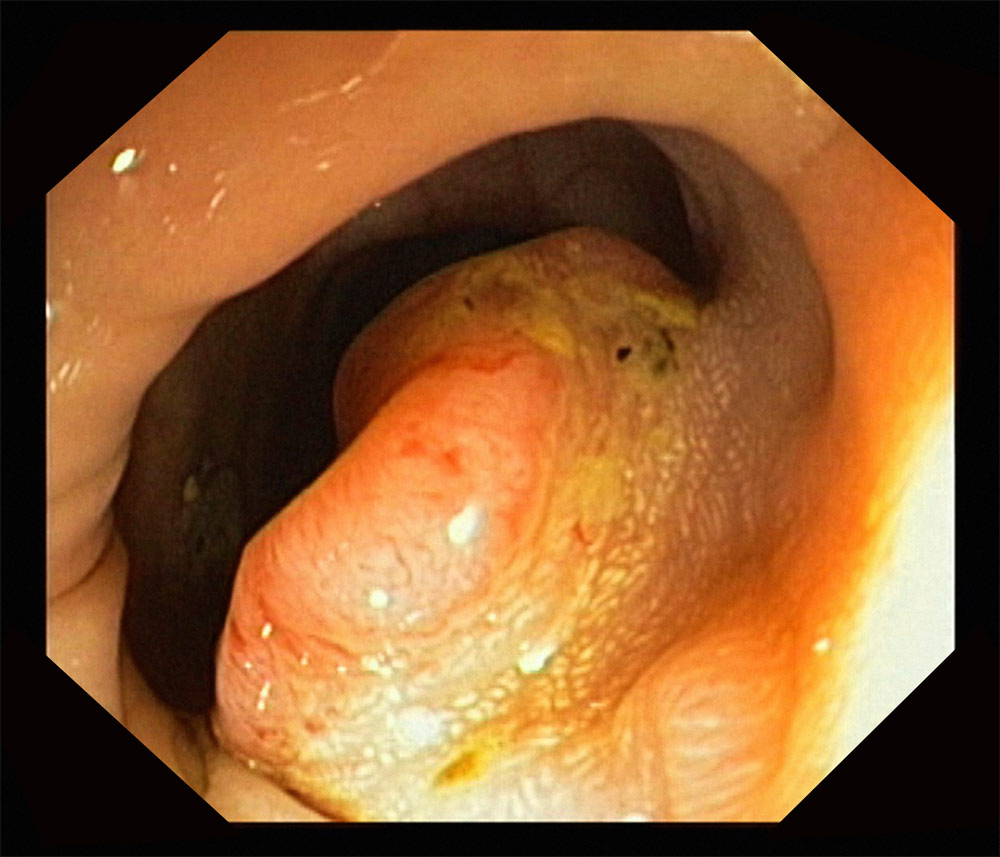 εικόνα από κολονοσκόπηση ασθενούς με καρκίνο που καταλαμβάνει το μισό περίπου αυλό του παχέος εντέρου.